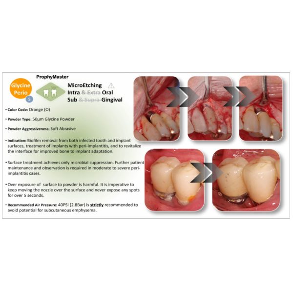 EtchMaster orange glycine tips for implant cleaning