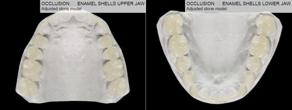 upper and lower edelweiss occlusion forms from DPS