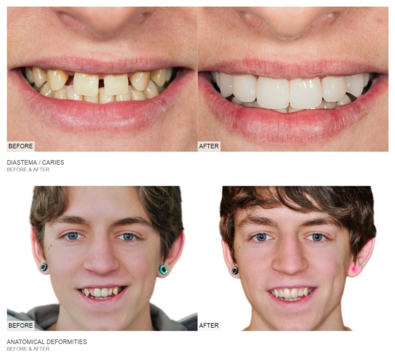 before & after dental treatment