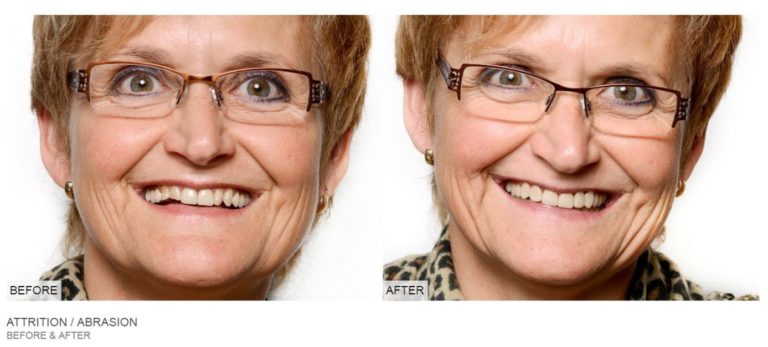 teeth before and after dental
