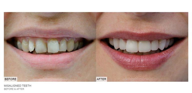 teeth before and after dental
