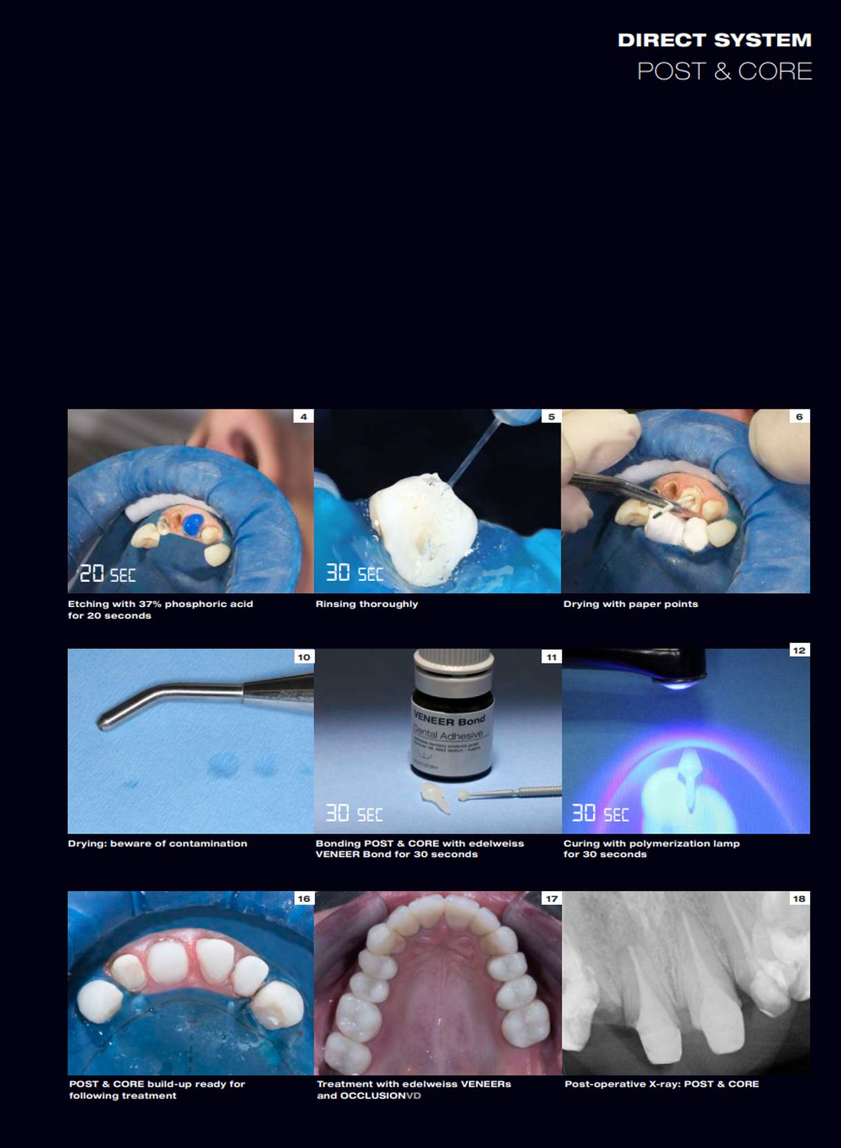 dental post & core system