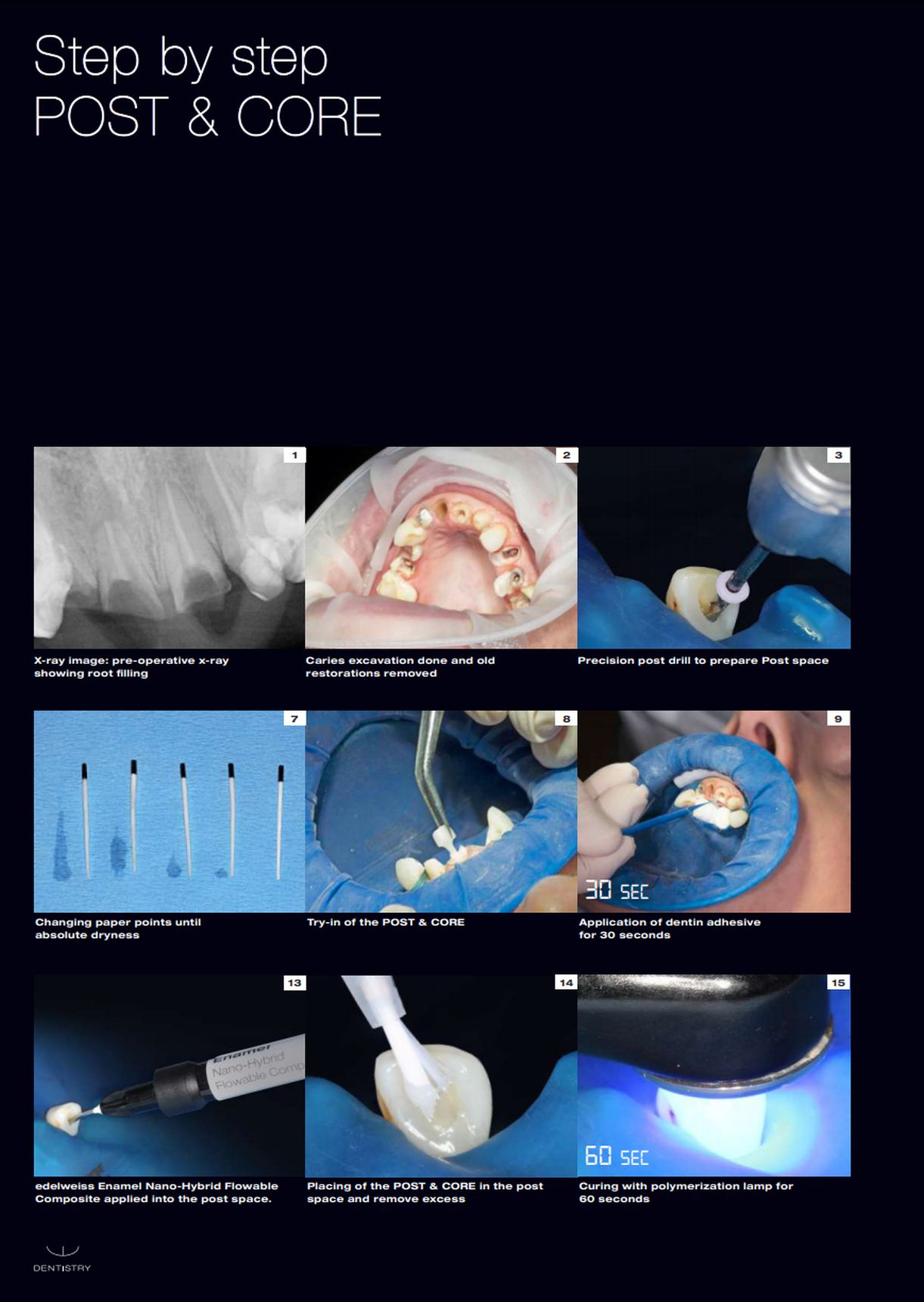 dental post & core info