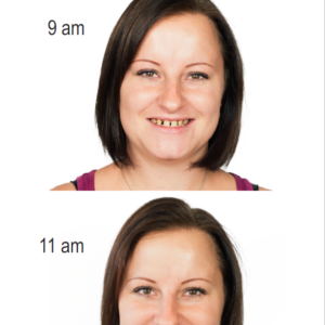 before/after dental veneers