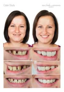 before/after teeth comparison