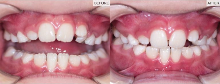 Paediatric Dental before/after