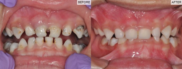 Paediatric Dental before/after