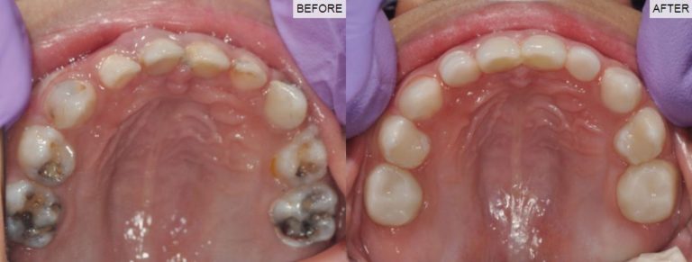 Paediatric before/after Dental Crowns