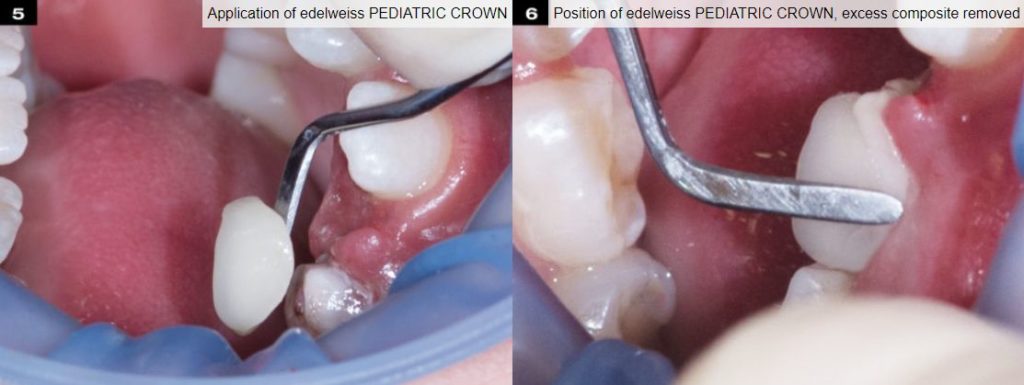 edelweiss paediatric crown fix
