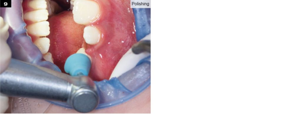 edelweiss Paediatric dental polishing