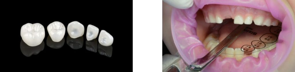 edelweiss paediatric dental crowns