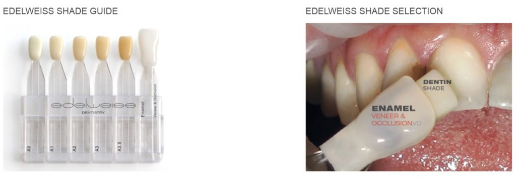 edelweiss dental veneers