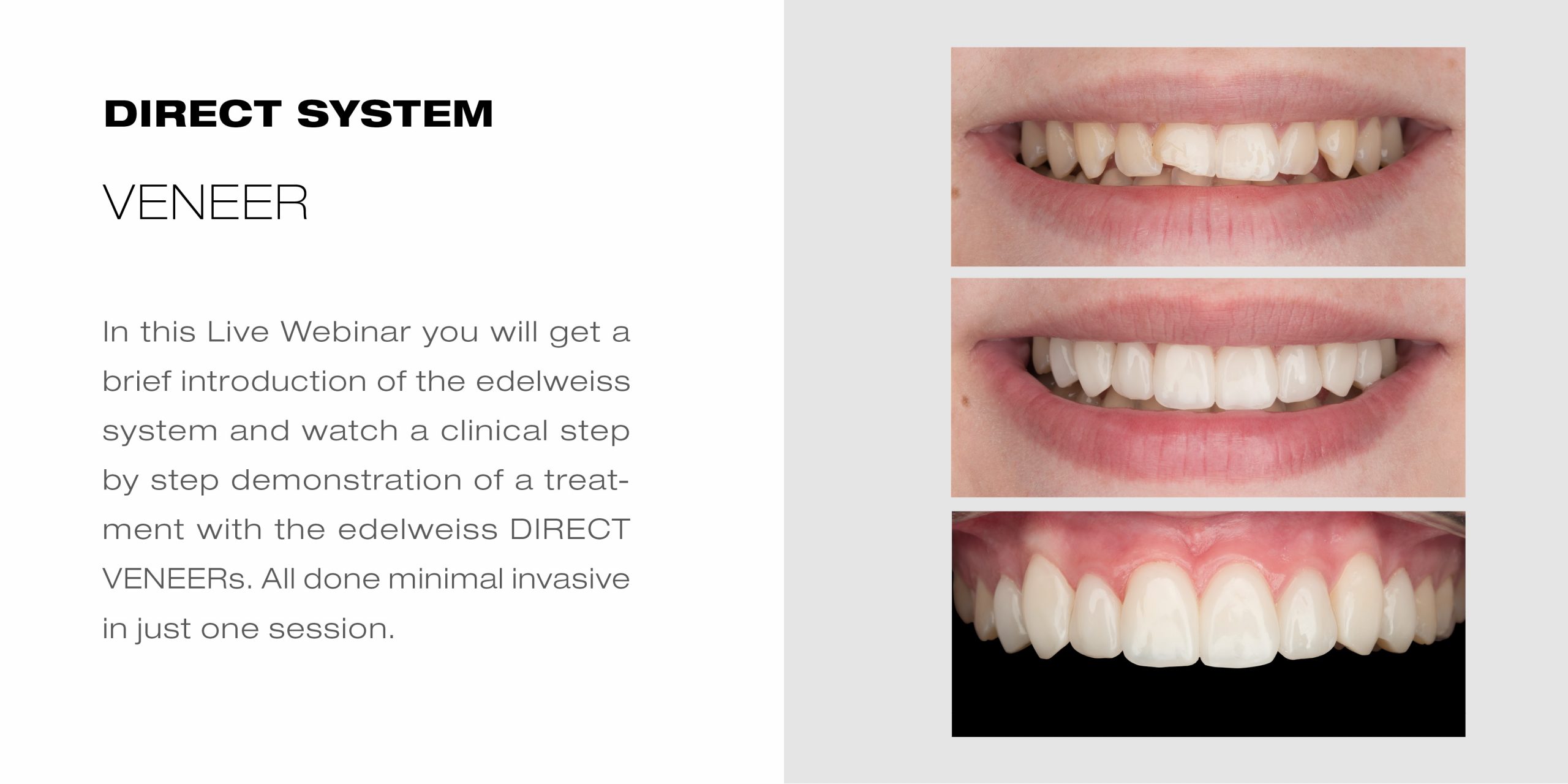 edelweiss minimal invasive smile makeover