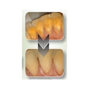 EtchMaster air abrasion and prophy adaptor from DPS