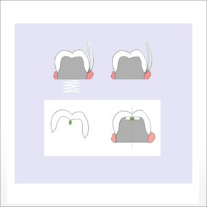 WAMkey gentle crown and bridge remover from DPS