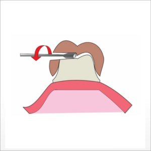WAMkey gentle crown and bridge remover from DPS