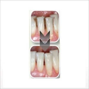 Green & Yellow EtchMaster tips