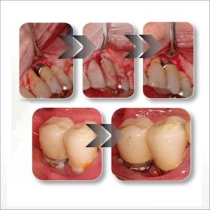 EtchMaster Orange Glycine tips from DPS